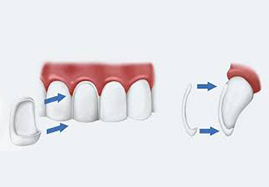 tandpand-reuver-dental-unique-facings-2